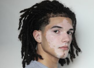 De vendedor de água no farol a modelo: jovem com vitiligo assina com agência de Alessandra Ambrósio Vitor Santos (Foto: Divulgação/Way Model)